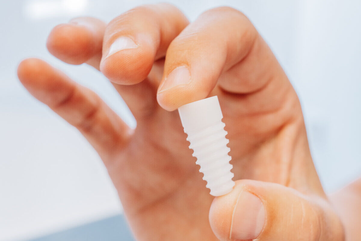 7 Dinge, die Sie vor einem Implantat in Nürnberg wissen sollten