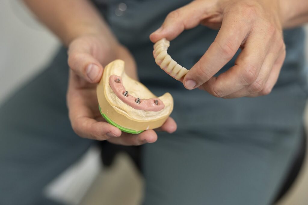 Festsitzende Brücke wird auf ein Oberkiefermodell mit vier Implantatpfosten gesetzt – feste Zähne an einem Tag bei Dr. Alius in Nürnberg
